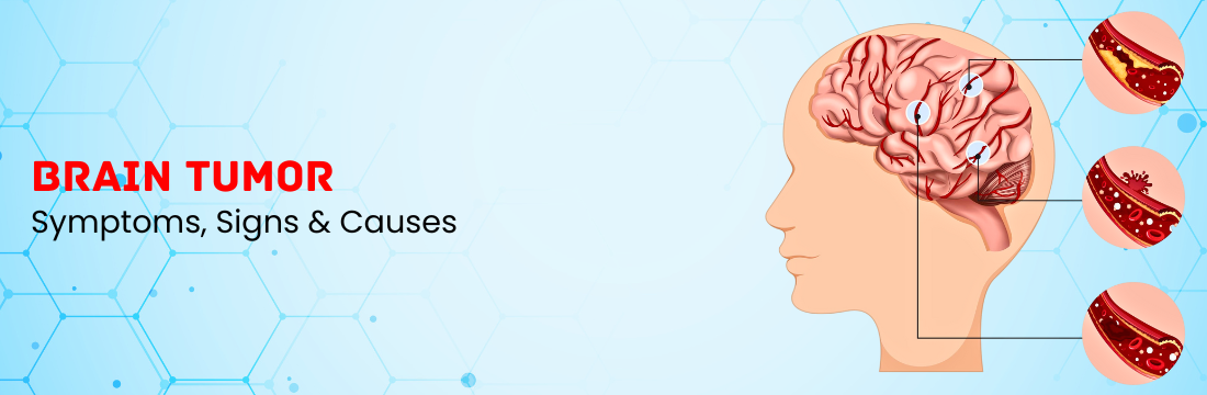 Brain Tumor: Symptoms, Signs & Causes